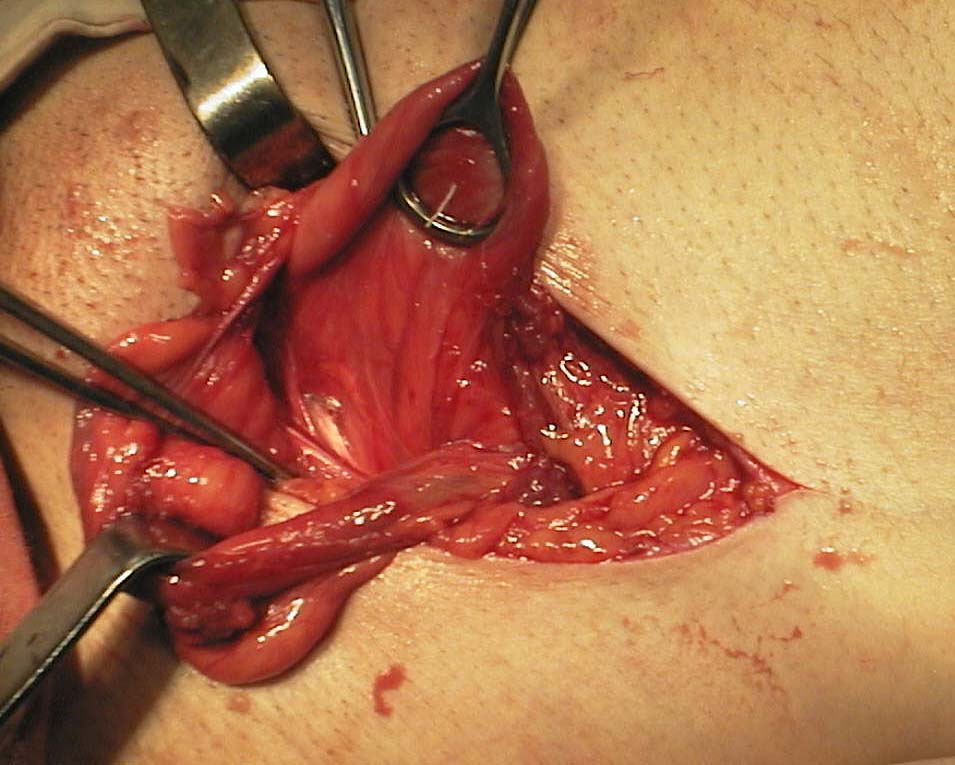 Tehnica laparoscopie hernie inghinala